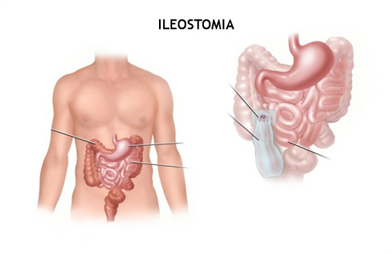 ileostomia